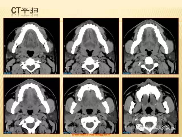 【病例】腮腺肌上皮瘤1例CT影像表现 【病例】腮腺肌上皮瘤1例CT影像表现