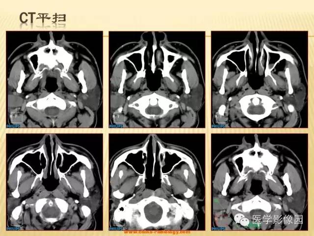 【病例】腮腺肌上皮瘤1例CT影像表现 【病例】腮腺肌上皮瘤1例CT影像表现
