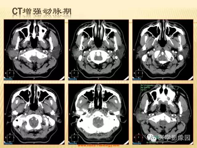 【病例】腮腺肌上皮瘤1例CT影像表现 【病例】腮腺肌上皮瘤1例CT影像表现