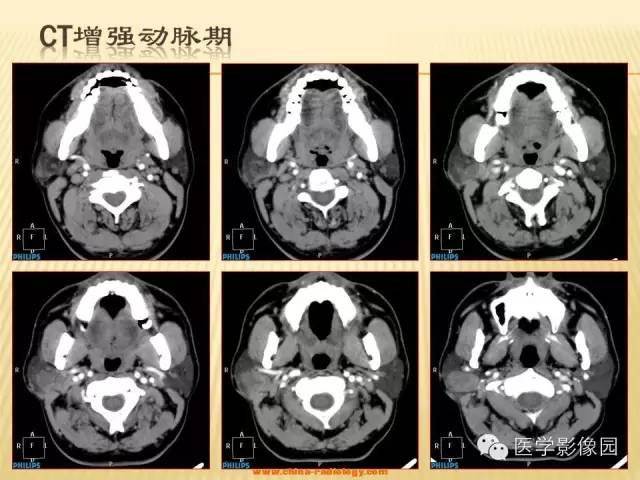 【病例】腮腺肌上皮瘤1例CT影像表现 【病例】腮腺肌上皮瘤1例CT影像表现