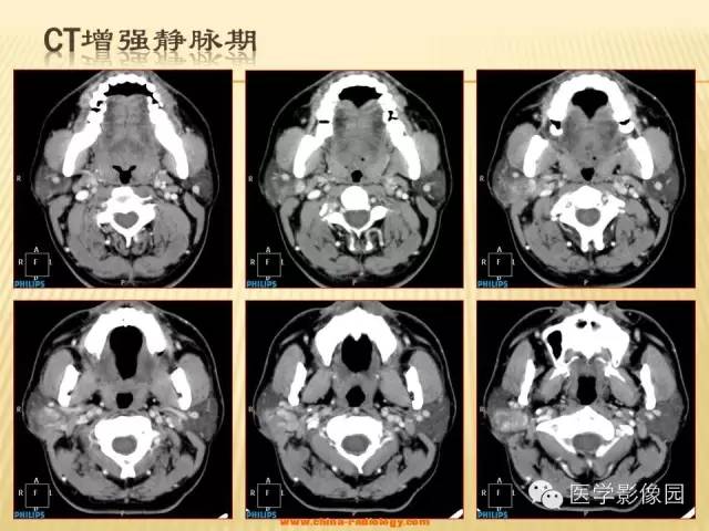 【病例】腮腺肌上皮瘤1例CT影像表现 【病例】腮腺肌上皮瘤1例CT影像表现