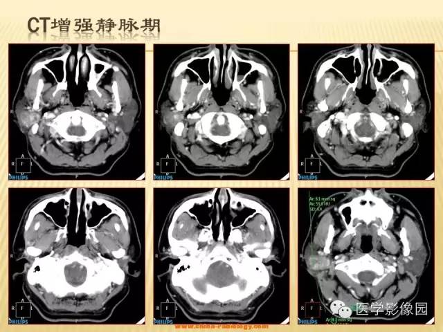 【病例】腮腺肌上皮瘤1例CT影像表现 【病例】腮腺肌上皮瘤1例CT影像表现