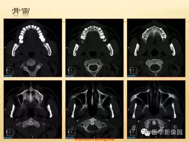【病例】腮腺肌上皮瘤1例CT影像表现 【病例】腮腺肌上皮瘤1例CT影像表现