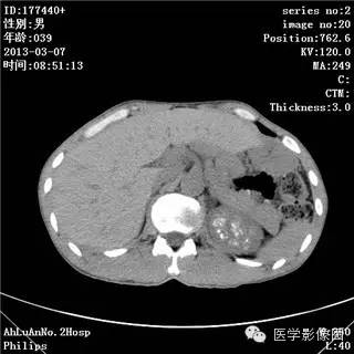 【病例】髓质海绵肾1例CT影像表现 【病例】髓质海绵肾1例CT影像表现