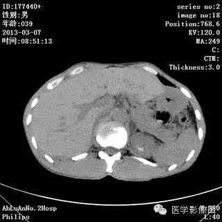 【病例】髓质海绵肾1例CT影像表现