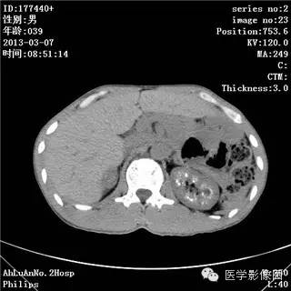 【病例】髓质海绵肾1例CT影像表现 【病例】髓质海绵肾1例CT影像表现