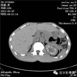 【病例】髓质海绵肾1例CT影像表现 【病例】髓质海绵肾1例CT影像表现