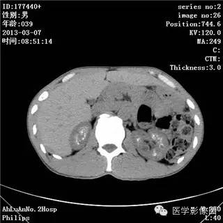 【病例】髓质海绵肾1例CT影像表现 【病例】髓质海绵肾1例CT影像表现