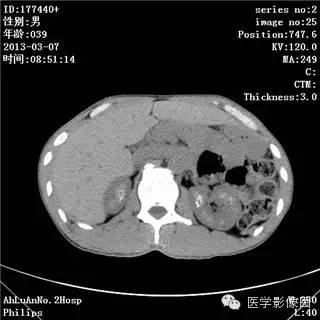 【病例】髓质海绵肾1例CT影像表现 【病例】髓质海绵肾1例CT影像表现