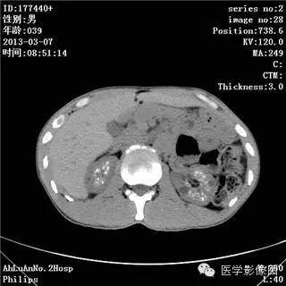 【病例】髓质海绵肾1例CT影像表现 【病例】髓质海绵肾1例CT影像表现