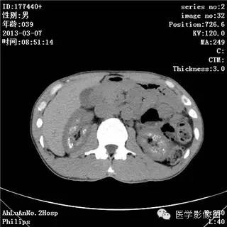 【病例】髓质海绵肾1例CT影像表现 【病例】髓质海绵肾1例CT影像表现
