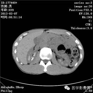 【病例】髓质海绵肾1例CT影像表现 【病例】髓质海绵肾1例CT影像表现