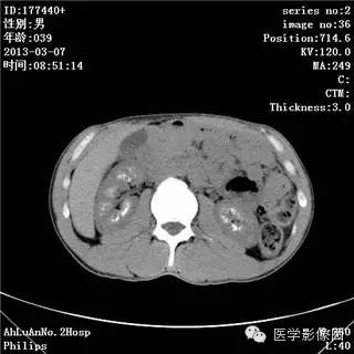 【病例】髓质海绵肾1例CT影像表现 【病例】髓质海绵肾1例CT影像表现