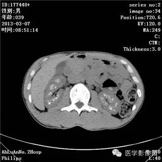 【病例】髓质海绵肾1例CT影像表现 【病例】髓质海绵肾1例CT影像表现