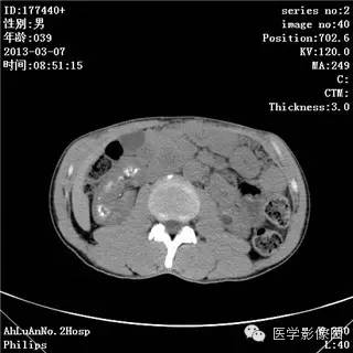 【病例】髓质海绵肾1例CT影像表现 【病例】髓质海绵肾1例CT影像表现