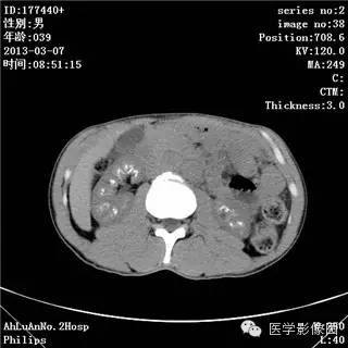 【病例】髓质海绵肾1例CT影像表现 【病例】髓质海绵肾1例CT影像表现