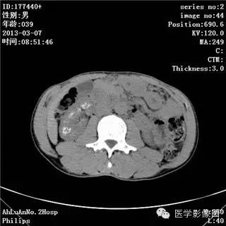 【病例】髓质海绵肾1例CT影像表现 【病例】髓质海绵肾1例CT影像表现