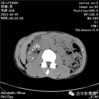 【病例】髓质海绵肾1例CT影像表现 【病例】髓质海绵肾1例CT影像表现