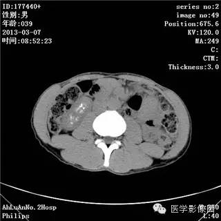 【病例】髓质海绵肾1例CT影像表现 【病例】髓质海绵肾1例CT影像表现
