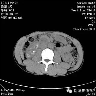 【病例】髓质海绵肾1例CT影像表现 【病例】髓质海绵肾1例CT影像表现
