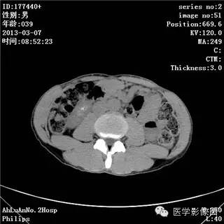 【病例】髓质海绵肾1例CT影像表现 【病例】髓质海绵肾1例CT影像表现