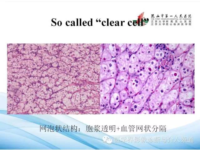 【PPT】肾透明细胞癌的CT表现和鉴别