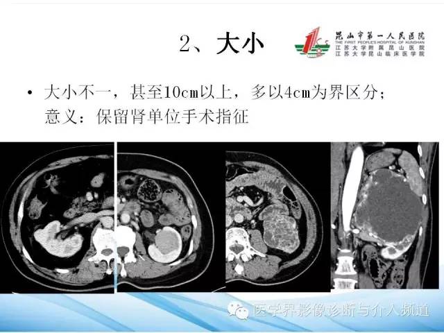 【PPT】肾透明细胞癌的CT表现和鉴别