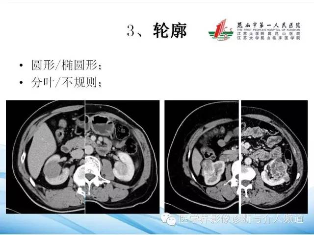 【PPT】肾透明细胞癌的CT表现和鉴别