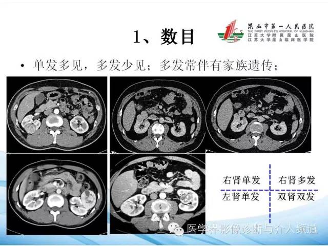 【PPT】肾透明细胞癌的CT表现和鉴别