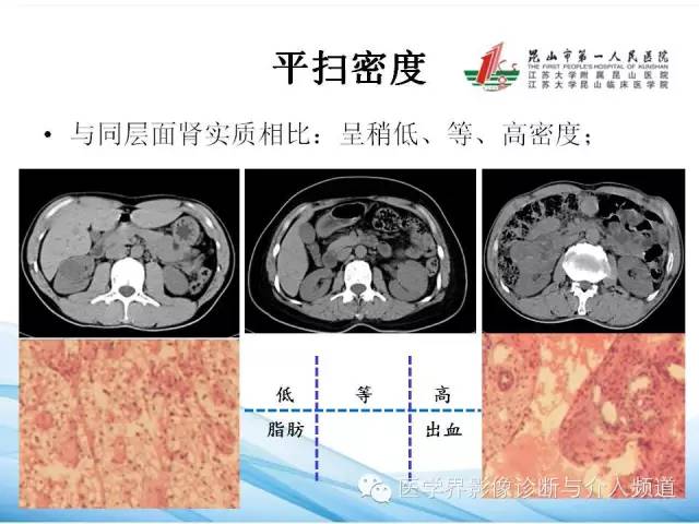 【PPT】肾透明细胞癌的CT表现和鉴别