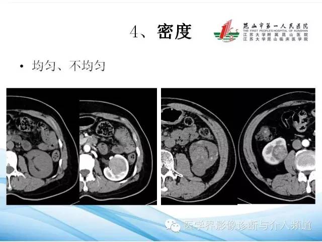 【PPT】肾透明细胞癌的CT表现和鉴别