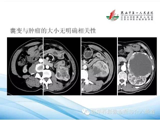 【PPT】肾透明细胞癌的CT表现和鉴别