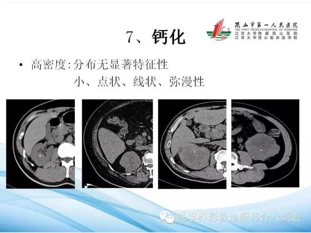 【PPT】肾透明细胞癌的CT表现和鉴别