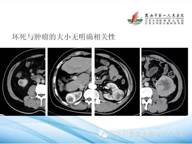 【PPT】肾透明细胞癌的CT表现和鉴别