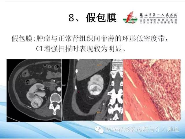 【PPT】肾透明细胞癌的CT表现和鉴别