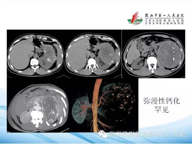 【PPT】肾透明细胞癌的CT表现和鉴别
