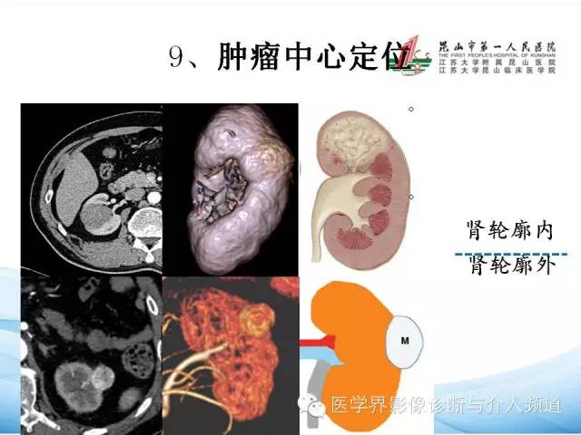 【PPT】肾透明细胞癌的CT表现和鉴别