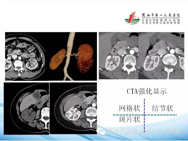 【PPT】肾透明细胞癌的CT表现和鉴别