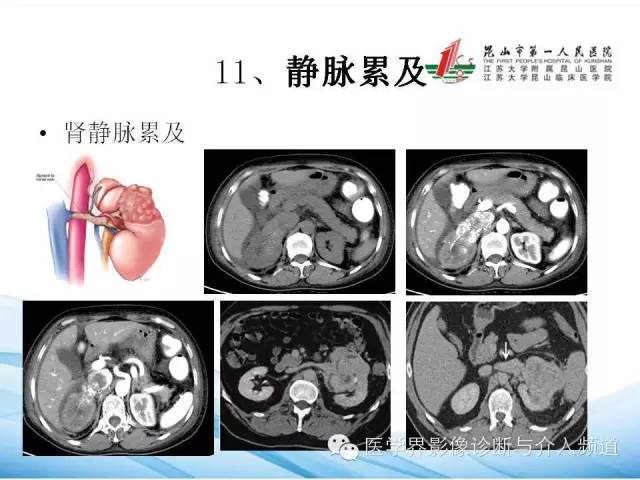 【PPT】肾透明细胞癌的CT表现和鉴别