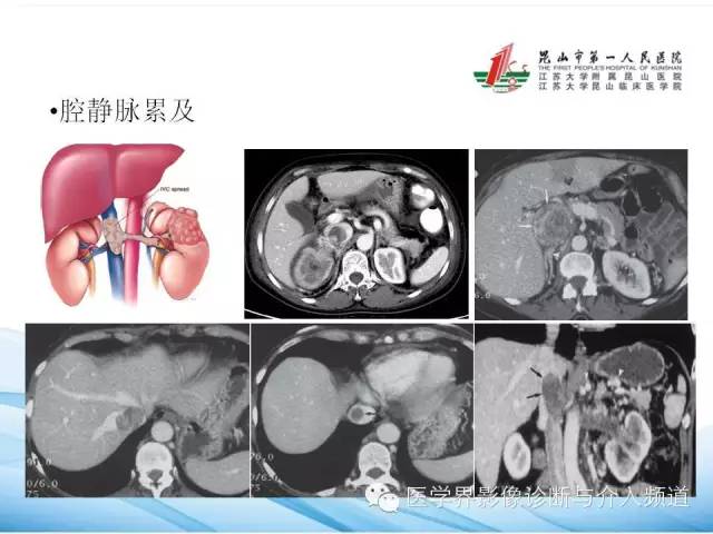 【PPT】肾透明细胞癌的CT表现和鉴别