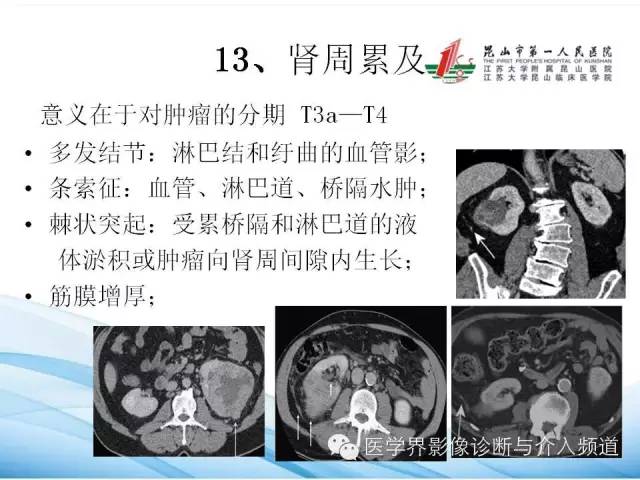 【PPT】肾透明细胞癌的CT表现和鉴别