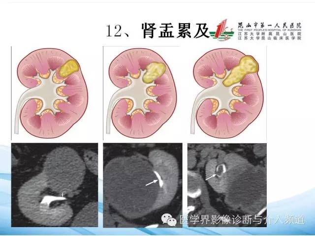 【PPT】肾透明细胞癌的CT表现和鉴别