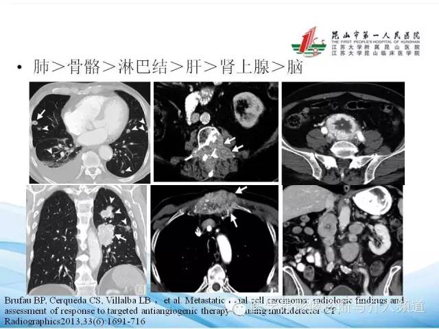 【PPT】肾透明细胞癌的CT表现和鉴别