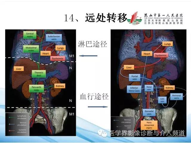【PPT】肾透明细胞癌的CT表现和鉴别