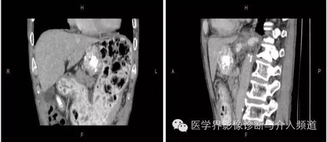 【病例】胃间质瘤1例CT影像表现与鉴别 【病例】胃间质瘤1例CT影像表现与鉴别