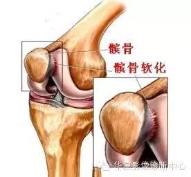 髌骨软骨软化症影像诊断 髌骨软骨软化症影像诊断