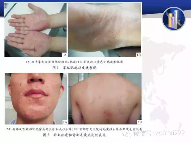 SAPHO综合征 SAPHO综合征