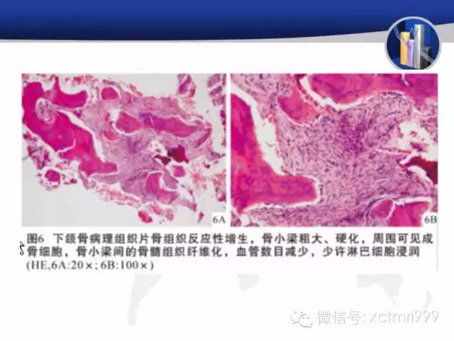 SAPHO综合征 SAPHO综合征