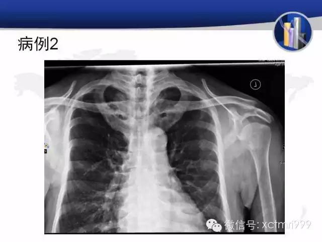 SAPHO综合征 SAPHO综合征