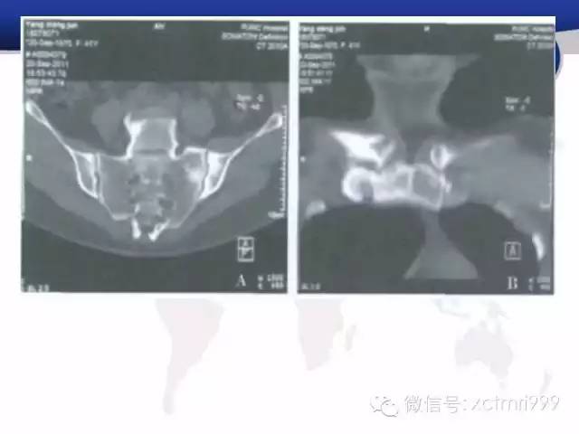 SAPHO综合征 SAPHO综合征